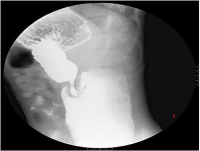 Intraluminal Diverticular Duodenal Duplication With Recurrent Abdominal Pain: A Case Report